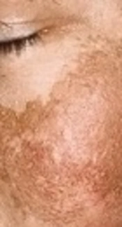 The Relationship Between Herbal Anticoagulants and Melasma